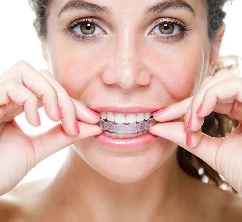 Transparente Aligner für Erwachsene
